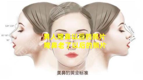 男人隆鼻以后的照片 隆鼻老了以后的照片